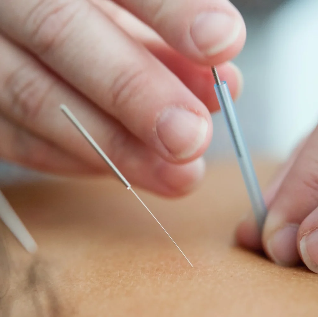 dry needling