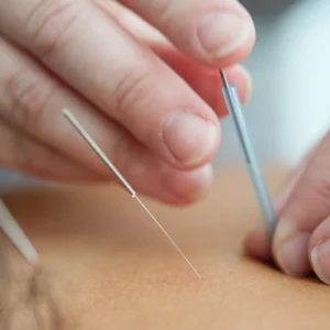 dry needling